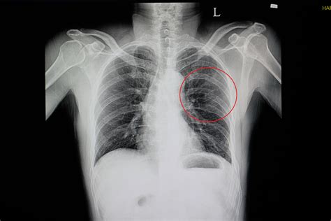 Rib Fractures Serious for Elderly Adults | The Oldish®