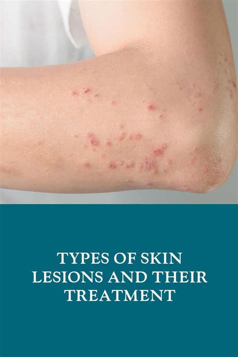 Types of Skin Lesions and Their Treatment | Dubai Cosmetic Surgery®