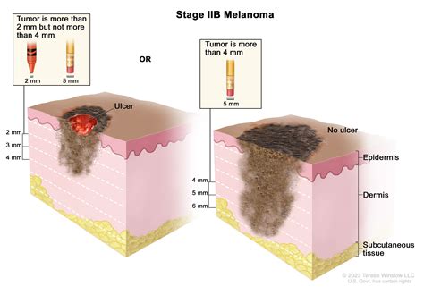 Melanoma Treatment (PDQ®) - NCI