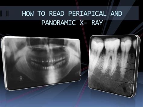 How make periapical x ray