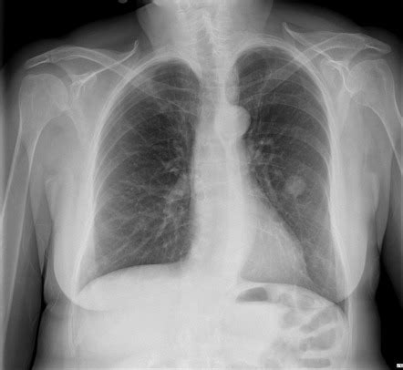 Pulmonary hamartoma | Radiology Reference Article | Radiopaedia.org