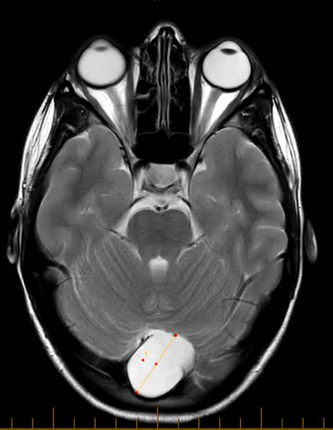 Arachnoid Cyst | C.N.S. Neurosurgery