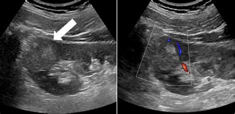 Kidney Ultrasound Tumor