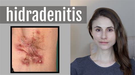 HIDRADENITIS SUPPURATIVA: Q&A WITH DERMATOLOGIST DR DRAY - YouTube