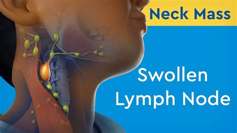 Swollen lymph nodes neck - dikiindustrial