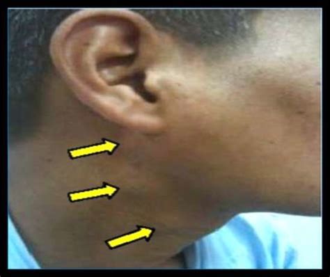 Swollen Parotid Lymph Node