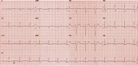 Can a giant U-wave be innocent? - The British Journal of Cardiology