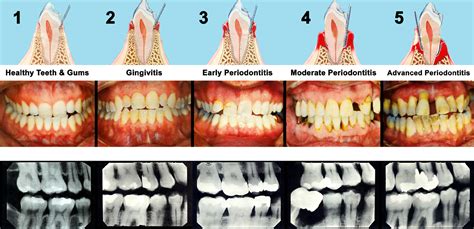 Preventive Care - Keeping Gum Diseases Away | Cornell Dental Centre