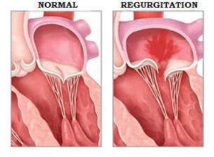 Mitral Regurgitation Explained • myheart.net