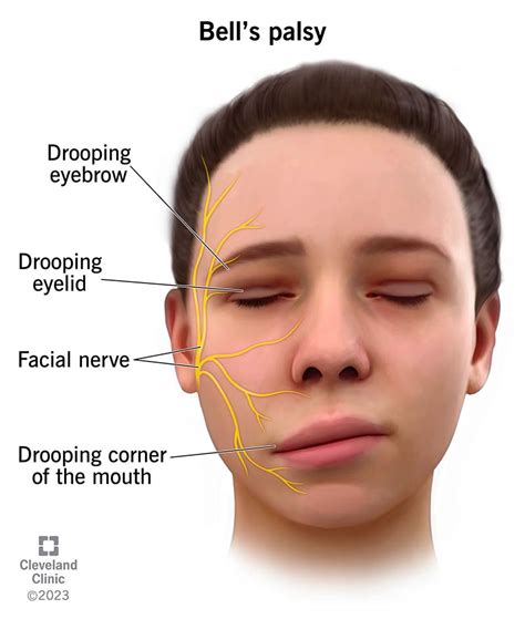 Bell's Palsy: What It Is, Causes, Symptoms & Treatment, face on ...