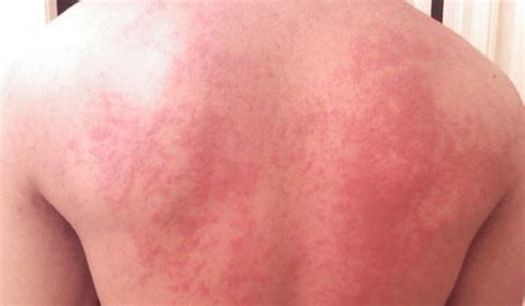 3 Hives Symptoms (and How to Treat Them) | Vujevich Dermatology