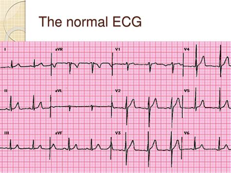 PPT - ECG interpretation for beginners - 1 PowerPoint Presentation, free download - ID:418039