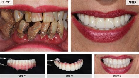 Dental Implants Results (Before & After) - 22 Cases