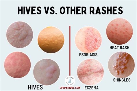 Hives (Urticaria) vs. Rash: Pictures and Differences