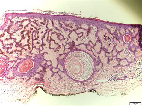 Pigmented Seborrheic Keratosis Pathology