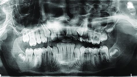 Preoperative radiograph (OPG) showing normal structures | Download ...