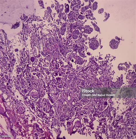 Tumor Dari Tulang Belakang Punggung Meningioma Psammomatosa Lesi Intrakranial Atau Massa Tulang ...