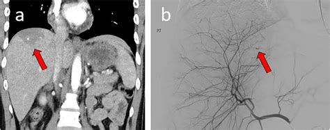 AAST grade III liver laceration (a) in segment 7 with possible... | Download Scientific Diagram