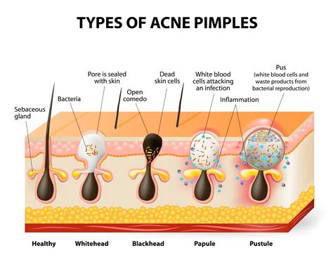 [DIAGRAM] Nodular Acne Diagram - MYDIAGRAM.ONLINE