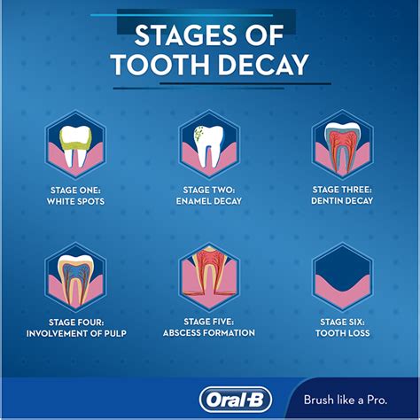 Stages Of Tooth Decay