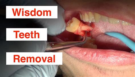 What you should know about wisdom tooth extraction pain