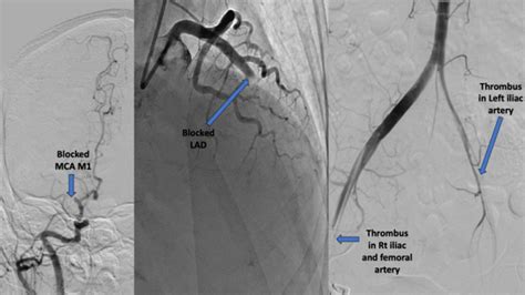 STEMI complications and beyond