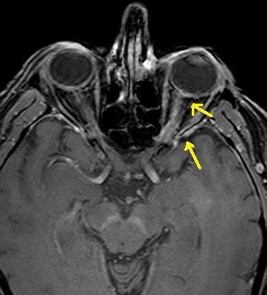 Optic Neuritis-MRI - Sumer's Radiology Blog