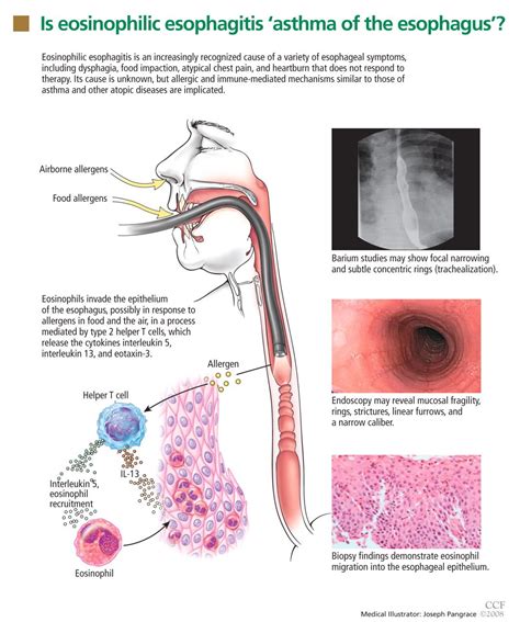 Until recently, the cause of intermittent or progressive difficulty swallowing solids was ...