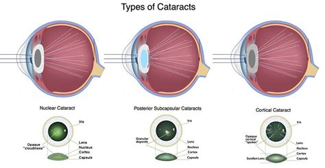 Cataract Diagnosis and Treatment MA | Northampton Eye