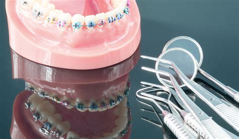 Broken Braces – Baker Street Dental