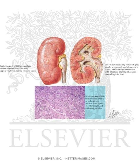 Acute Pyelonephritis: Pathology