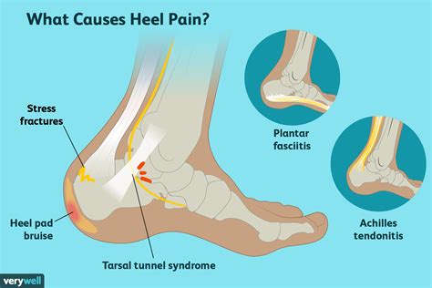 Foot Pain Diagram - exatin.info