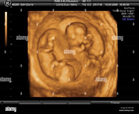 A 3D ultrasound scan of a twin pregnancy at 12 weeks gestation Stock ...