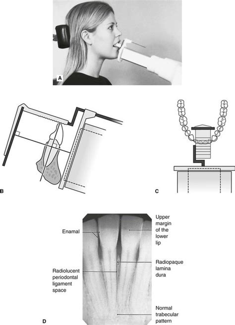 periapical x ray techniques - paintingtitleitalicsorquotes