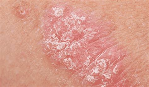 What Is Psoriasis? | psoriasisSPEAKS