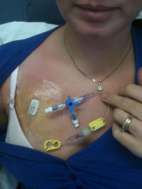 Vanquishing Triple Negative Breast Cancer My Way: Chemo Session One, Done and Dusted