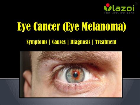 Eye Cancer (Eye Melanoma): Symptoms, Causes, Diagnosis and Treatment. by lazoithelife - Issuu