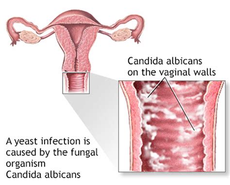 Yeast Infection Sores Vs Herpes