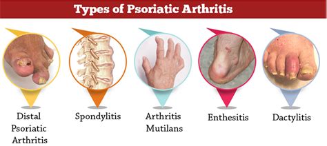 Psoriatic Arthritis - Causes, Symptoms, Diagnosis, Diet & Treatment