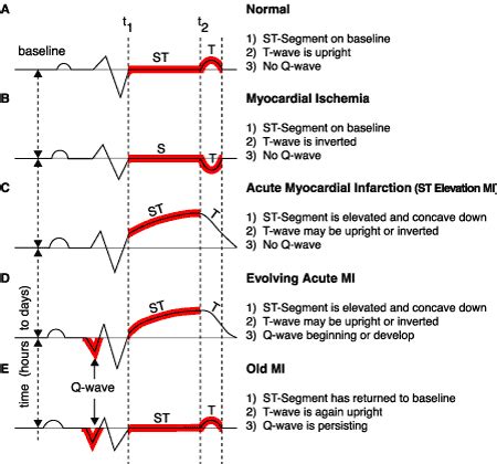 “T” is for T-wave Inversion - ECGcourse.com