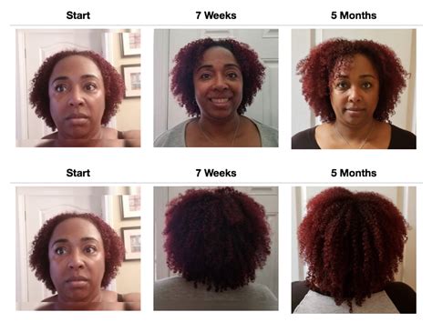 38+ hair growth before and after 6 months - OgdenAlia