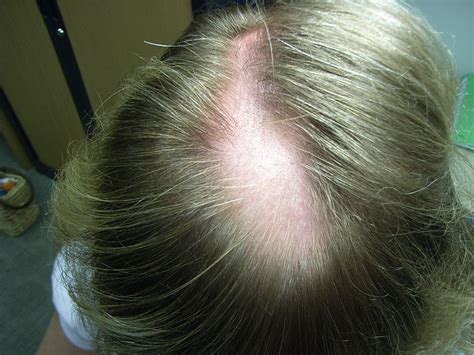 Medical Pictures Info – Alopecia Areata