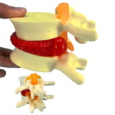 Buy Human Anatomical Lumbar Disc Herniation Model, 1.5 Times Life Size Lumbar Disc Herniation ...