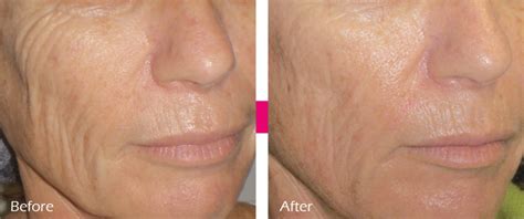 Radio Frequency Skin Tightening – IPL Skincare Clinique