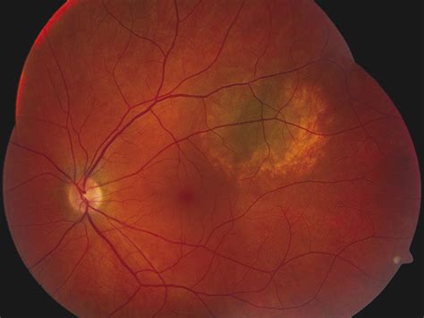 Choroidal Nevus | Ento Key