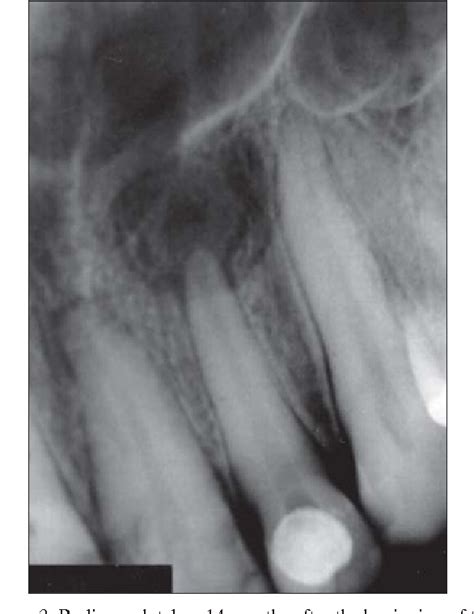 Figure 1 from Periapical cyst repair after nonsurgical endodontic therapy--case report ...