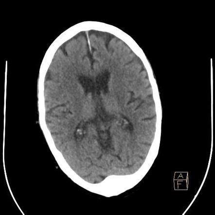 Arachnoid granulation | Radiology Case | Radiopaedia.org