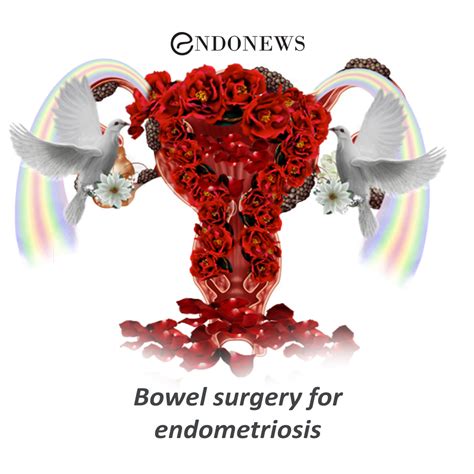 Bowel surgery for endometriosis | EndoNews