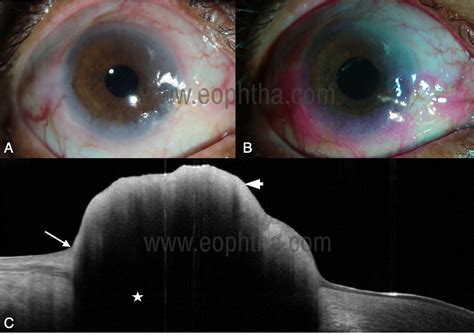 Ocular Surface Squamous Neoplasia