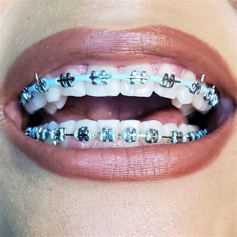 √ Lavender Braces Color